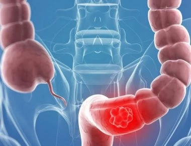 Τα ύποπτα σημάδια του καρκίνου του παχέος εντέρου